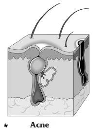 Illustration of pimple through the layers of skin.